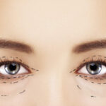 Blepharoplasty in Cincinnati